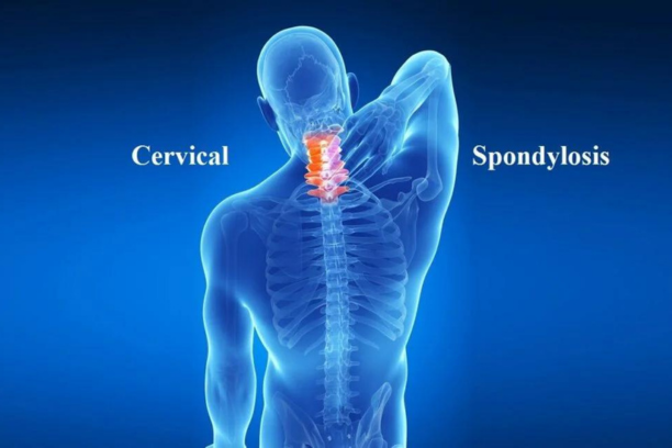 Combating Cervical Spondylosis: Aspire Clinic Strategies